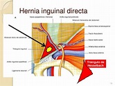 Diagnóstico de hernia inguinal por TC