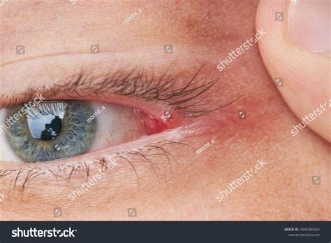 Eyelid Pimple Macro Close Pimple Near Stock Photo 1800289264 Shutterstock
