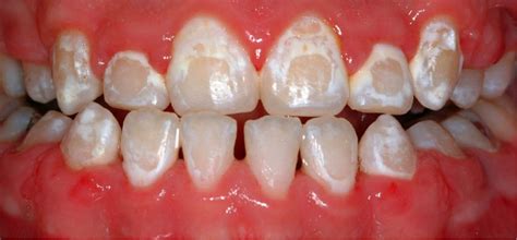 Lingual Orthodontics Lingual Orthodontic Braces Ireland