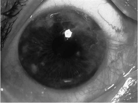 Corneal And Conjunctival Degenerations Ento Key