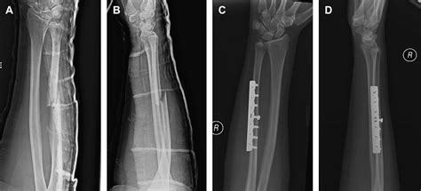 Pdf Management Of Isolated Ulnar Shaft Fractures Semantic Scholar