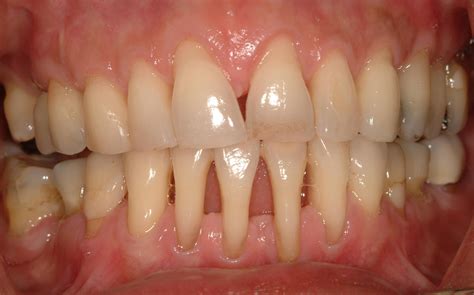 Periodontal Gum Disease Institute Of Dental Implants Periodontics