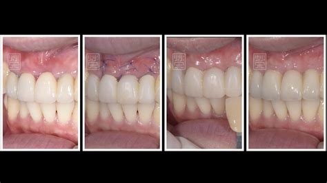 牙齦邊緣萎縮，瓷牙冠邊緣變黑，橋體下牙齦萎縮————全瓷牙橋併牙齦移植手術 案例介紹 美容牙科張凱榮醫師