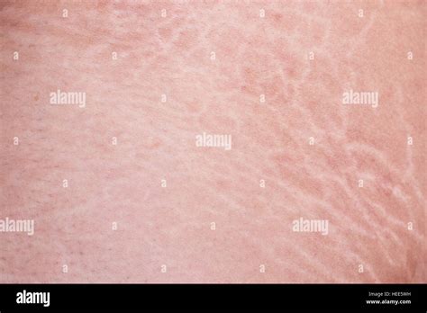 Macro Stretch Marks Of Skin On The Thigh Stock Photo Alamy