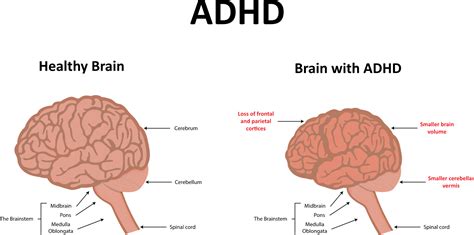 Add Vs Adhd Whats The Difference Neurogrow Brain Fitness Center