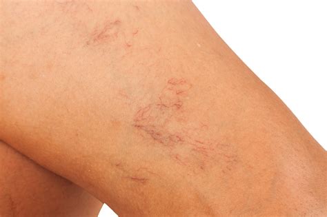 What Happens If You Dont Treat Leg Veins The Vein Center Of Maryland