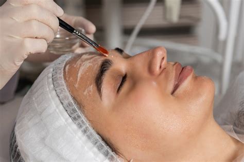 Your Quick Guide To Longer Lasting Chemical Peels For Hyperpigmentation