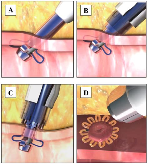 Clinical Experience With A Circumferential Clip Based Vascular Closure