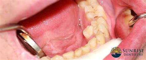 What Is Hyperdontia Causes Symptoms And Treatments