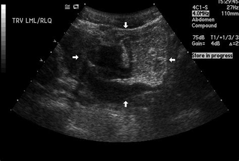 Sonographic Findings In A Case Of Crohn Disease Jennifer Bagley