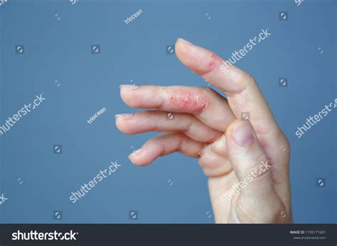 Atopic Hand Dermatitis Eczema On Fingers Stock Photo 1739171681