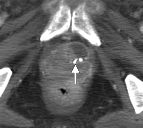 Imaging Of The Female Perineum In Adults Radiographics