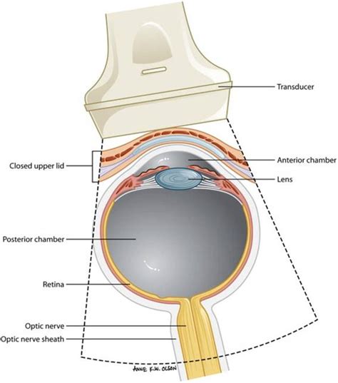 Optic Nerve Sheath Diameter Window To The Soul Broome Docs