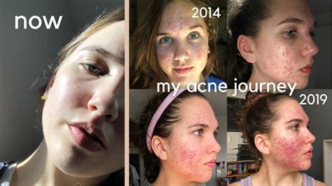 How I Cleared My Acne After 5 Years My Struggle With Acne Youtube