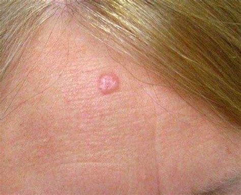 Skin Cancer Types On The Face What Are The Most Common Malignant Skin
