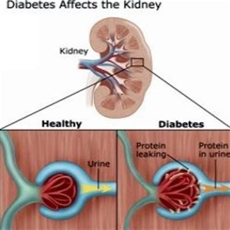Treating diabetes is best carried out during the early stages of the disease when the consequences can still be controlled and minimized. EFFECTIVE RENAL DIABETIC DIET | Diabetic & Kidney info ...