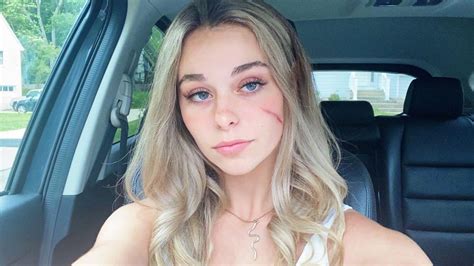 Tiktoks ‘scar Girl Opens Up About Viral Fame Rolling Stone Pedfire