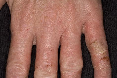 Dry Eczema On Hands Pictures 475 Photos And Images