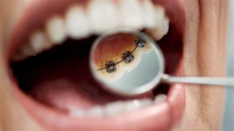 Qu Est Ce Que L Orthodontie