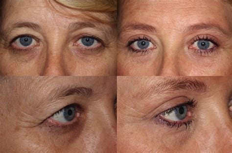 Brow Lift Upper And Lower Blepharoplasty And Ptosis Repair Left Eye