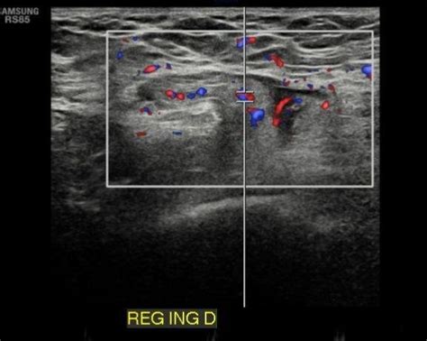 Ultrasound Of Inguinal Region Highlighting Incarcerated Hernia With