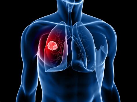 Passive exposure to tobacco smoke (passive smoking) also can cause. CT Lung Cancer Screening Albuquerque | Diagnostic Imaging ...