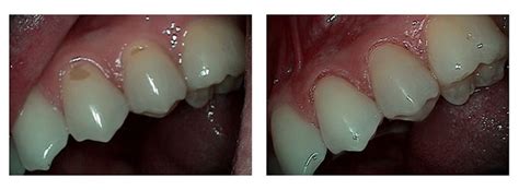 Tooth Abfraction Treatment