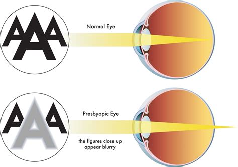 Lasik For Presbyopia In Chicago Kraff Eye Institute