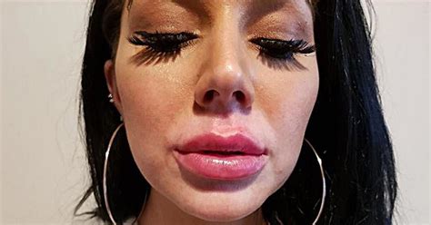 Model Warns Of ‘boozy Botox Parties After She Was Left With Swollen