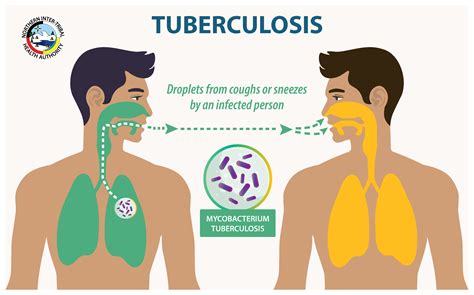 Tuberculosis – NITHA | Northern Inter-Tribal Health Authority