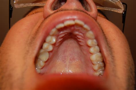 Oral Cancer As Related To Soft Palate Pictures