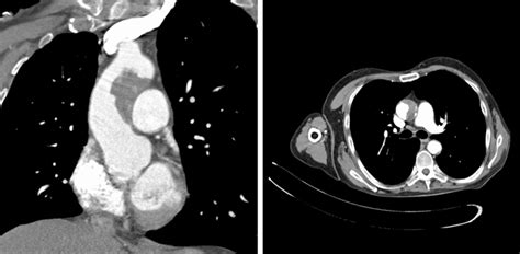 Ct Aortogram Demonstrating A Bovine Aortic Arch And Large Download