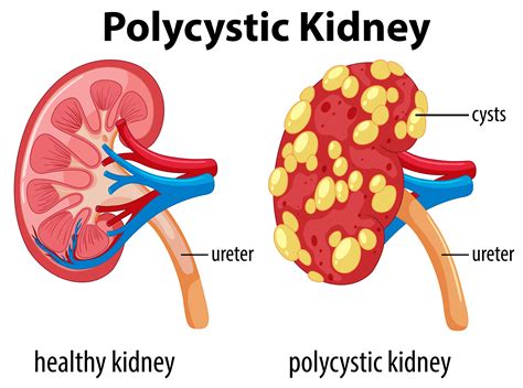 Diagram Showing Polycystic Kidney 431412 Vector Art At Vecteezy
