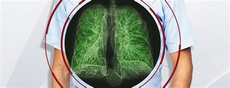 Low Dose Ct Lung Cancer Screening Ldct Maryland