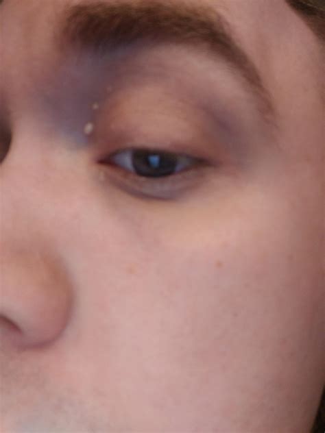 Ive Got White Spots Above My Eye That Just Appeared Over The Last Two