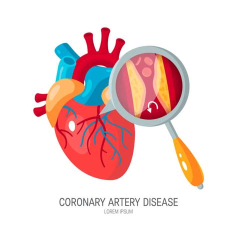 Top 60 Clogged Arteries Clip Art Vector Graphics And Illustrations