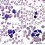 Numerous Atypical Lymphocytes Were Seen In The EDTA Anticoagulated 