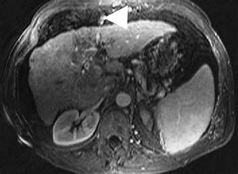 Ct And Mri Of Hepatic Contour Abnormalities Ajr