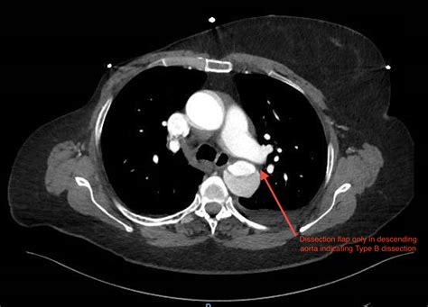 Renal Infarction From Type B Aortic Dissection Jetem
