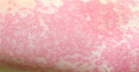 Swimming Pool Rash Images What Is A Chlorine Rash With Pictures