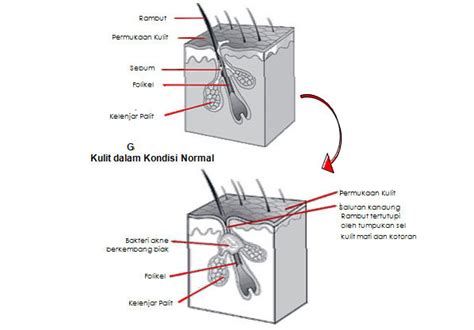 Kondisi Abnormal Pada Rambut Yang Disebabkan Oleh Jamur