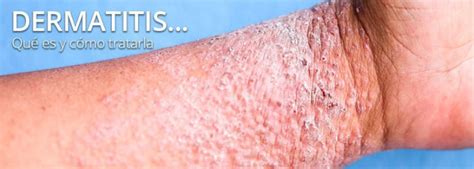 Dermatitis Qu Es Y Qu Tratamientos Tiene Tecnosa