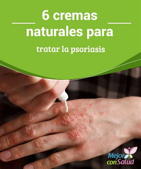 6 Cremas Naturales Para Tratar La Psoriasis Psoriasis Remedios