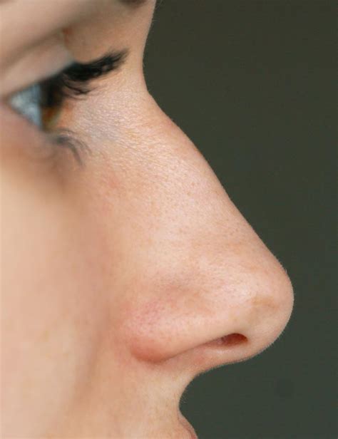 Nose Bump Treatment London Sas Aesthetics Marylebone