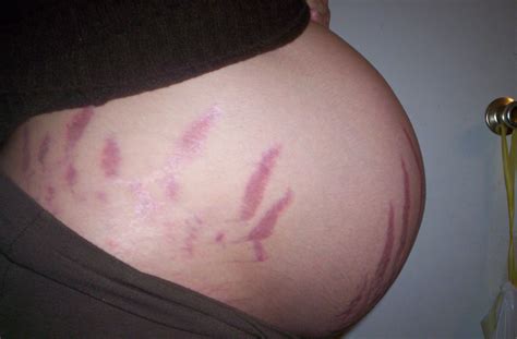 Pregnancy Stretch Marks Photo Gallery