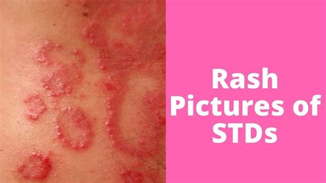 Skin Rashes That Itch Identification Porn Sex Picture