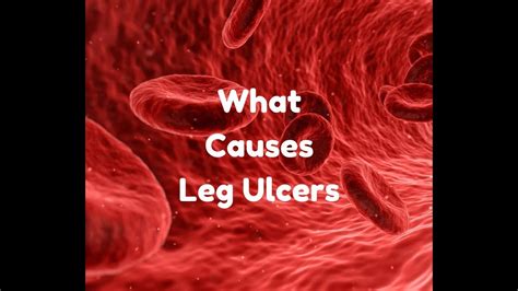 What Causes Leg Ulcers Youtube