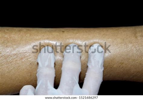 Doctor Testing Pitting Oedema Leg Patient Stock Photo Edit Now 1521686297