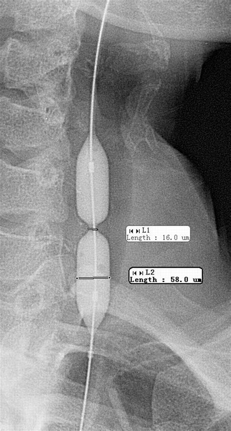 Fluoroscopically Guided Balloon Dilation Of Benign Esophageal