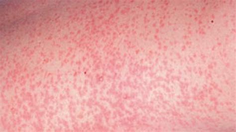 German Measles Rubella Causes Symptoms And Treatments